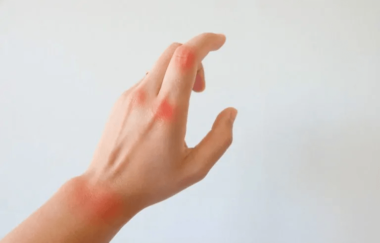דלקת פרקים באצבעות הידיים